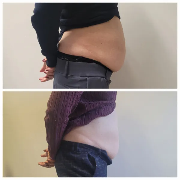 Efekt zabiegów liposukcji laserowej Vivien 1064 nm